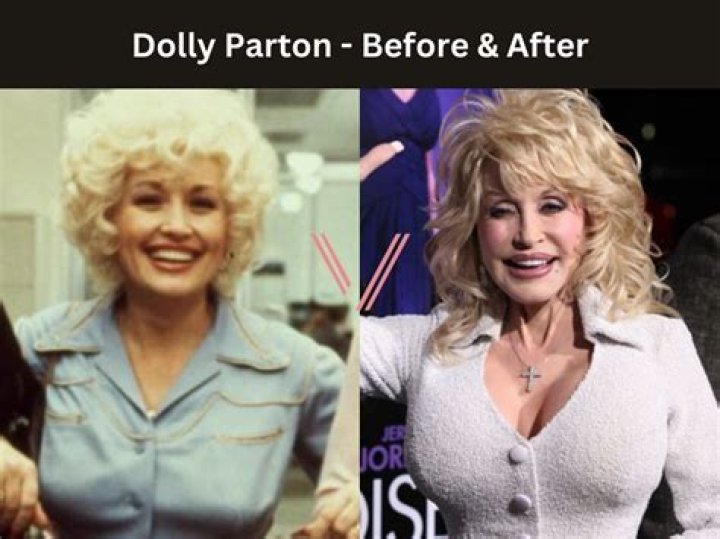 Dolly Parton got breast reduction surgery because her trademark 40DD 'Virginia Twins' were killing h